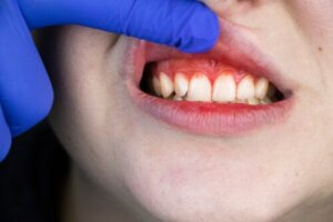Origin, Symptoms, and Treatment of Trench Mouth