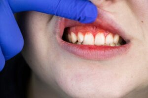 Origin, Symptoms, and Treatment of Trench Mouth