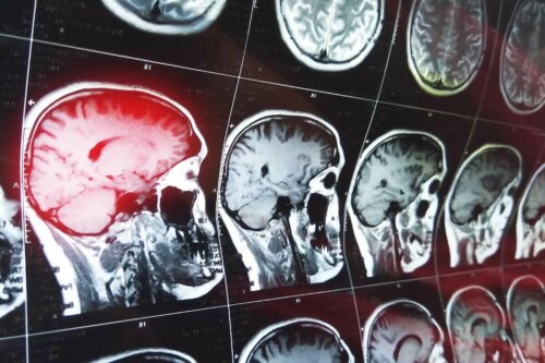 Confabulations after brain damage.