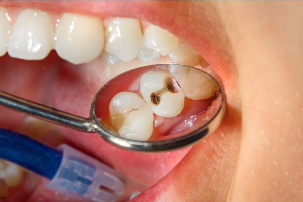 Huller i tænder