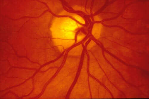 What's Scleral Buckling Surgery?