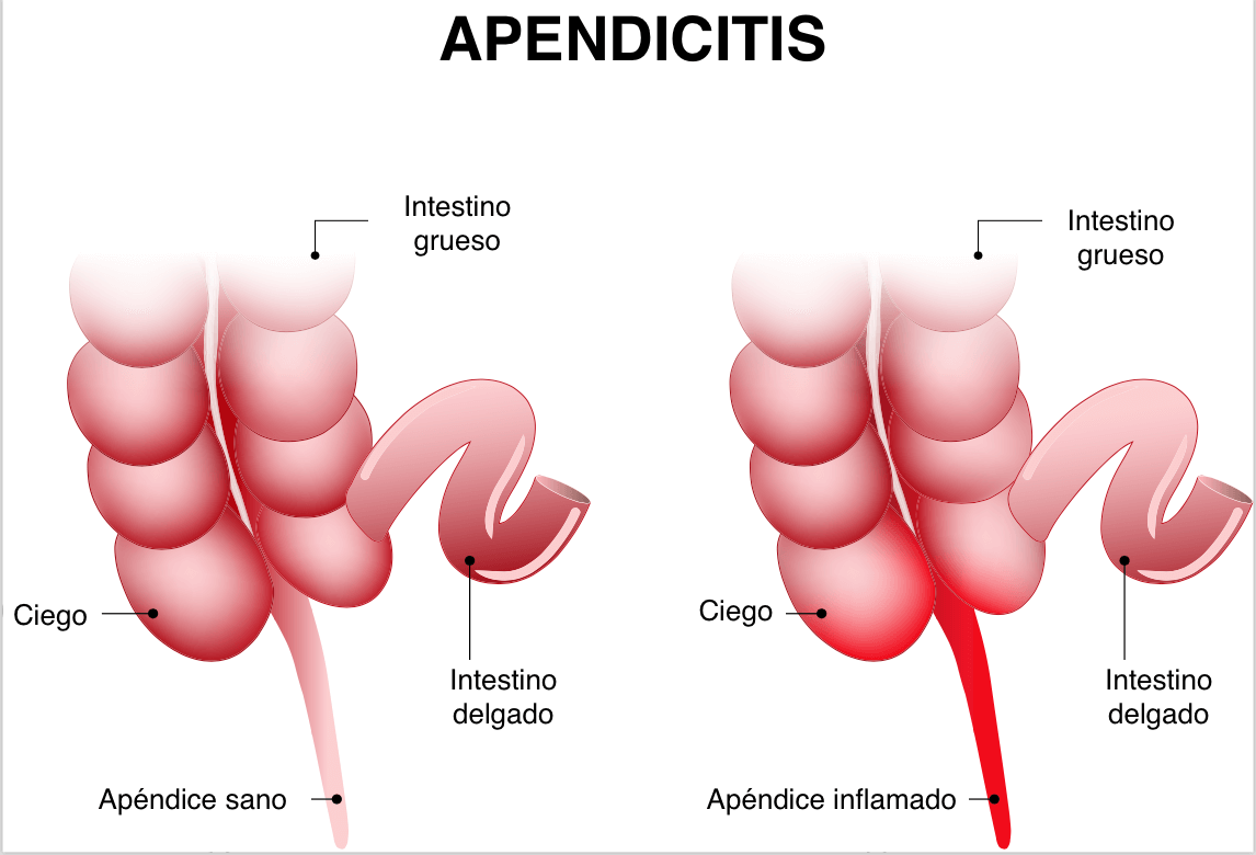 An image of a healthy appendix next to an inflamed intestine.