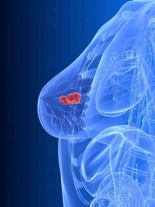 Fulvestrant - Brustkrebs mit Hormontherapie behandelt