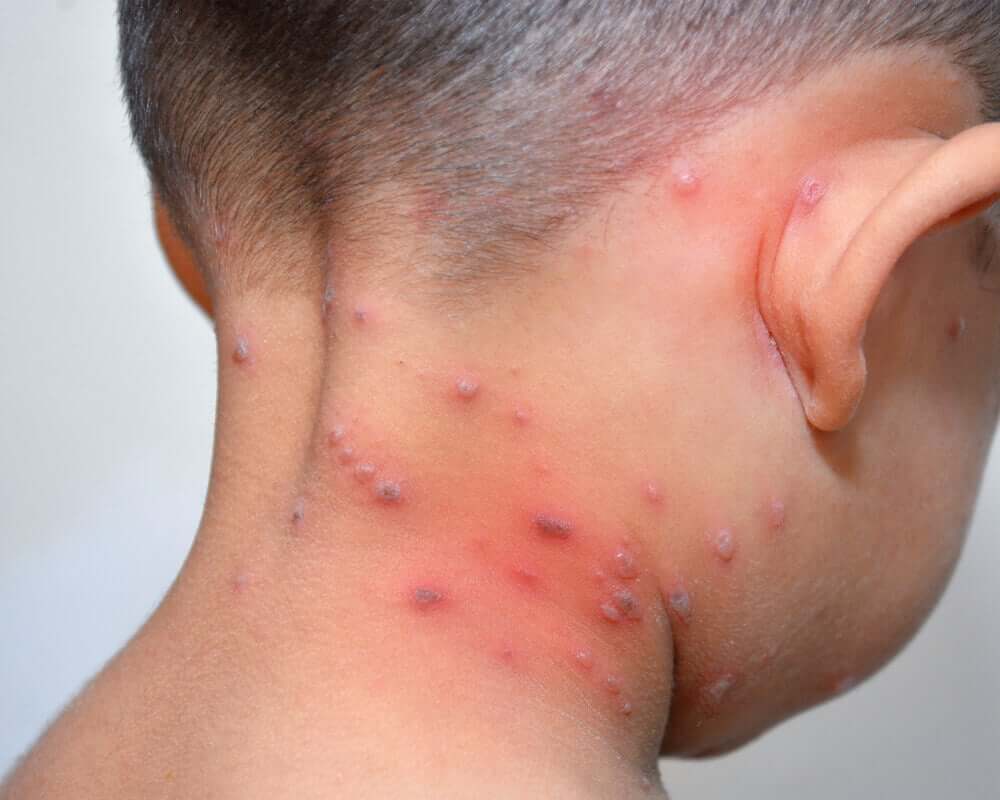 A small child with blisters on his neck.