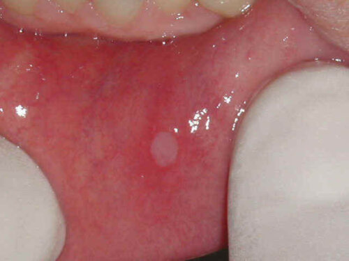 Close up of a mouth sore.