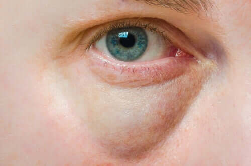 Causes of Puffy Eyelids and Treatments