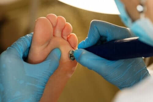 Medical Treatment for Calluses on Hands and Feet