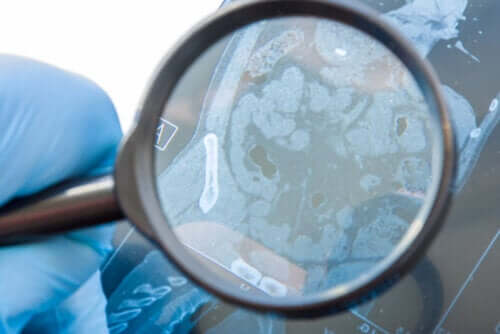 What Is a Gastrointestinal Fistula and What Causes It?