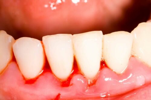 Inflamed gums due to gingivitis.
