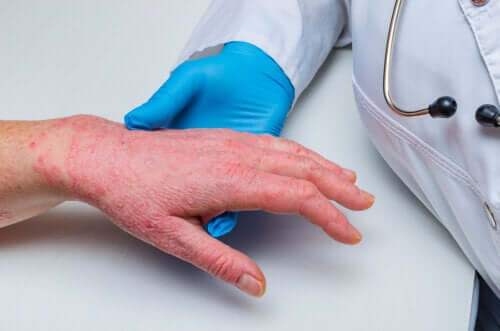 Psoriasis and Coronary Heart Disease: How Are They Related?