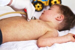 Scalded Skin Syndrome: Causes and Symptoms
