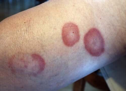 Red circular lessions on a person's arm.