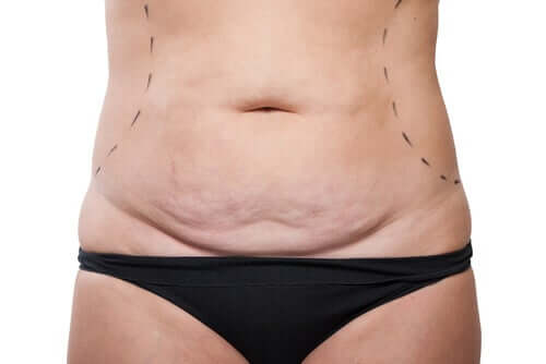 A woman who's had various pregnancy and is going to have tummy tuck.