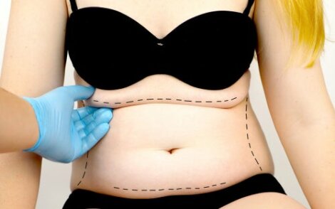 What is Abdominoplasty, or Abdominal Wall Surgery?