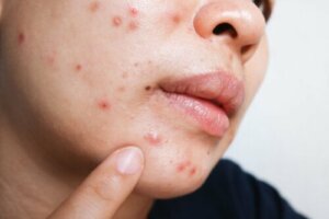 Benefits and Side Effects of Isotretinoin for Acne