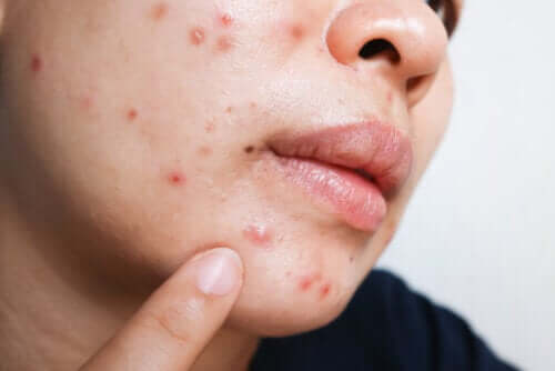 Benefits and Side Effects of Isotretinoin for Acne