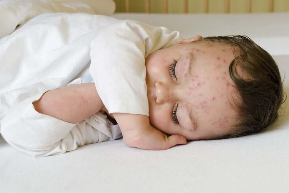 En baby med skoldkopper
