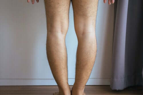 Genu Varum or Bowlegs: Causes and Treatment