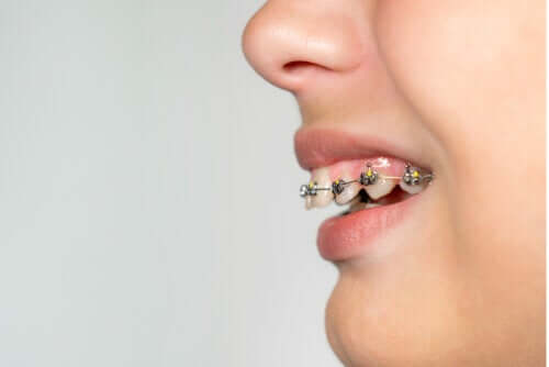 What's an Overbite and How Can You Treat it?