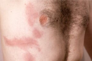 Rib Contusion: Causes, Symptoms and Care
