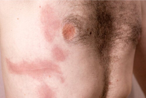 Rib Contusion: Causes, Symptoms and Care