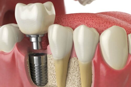 dental implant close up cartoon