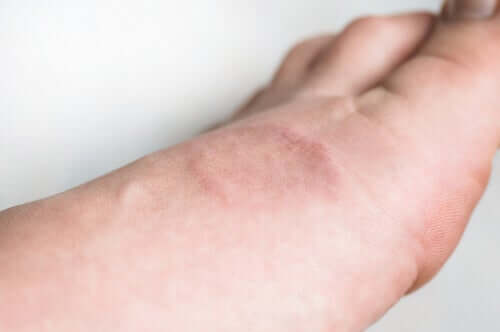 The Symptoms and Treatment of Granuloma Annulare
