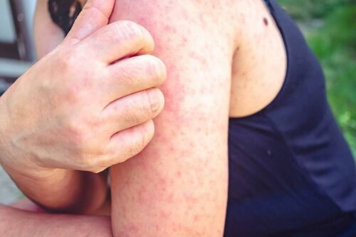 woman with a rash on her arm scratching it