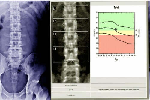 What is a Bone Densitometry?