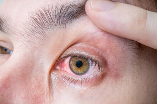 Ocular Melanoma: Symptoms and Causes