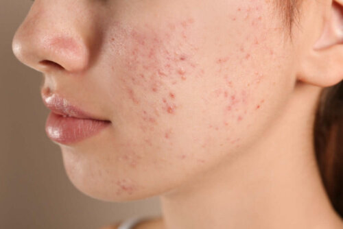 A person with acne.