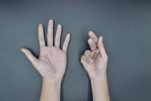 Causes of Dupuytren's Contracture and Treatments