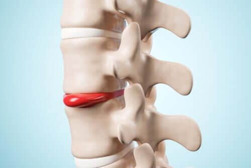 A model of the spinal column with a herniated disc.