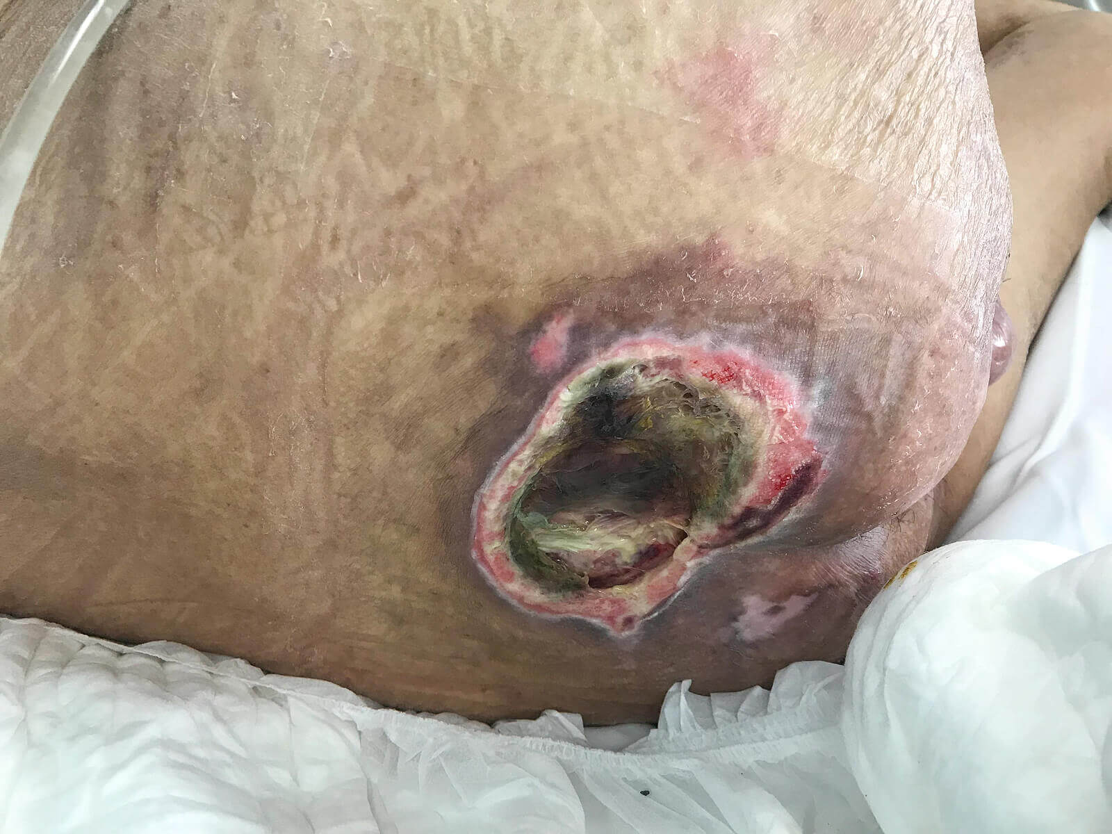 A person with a serious bedsore.