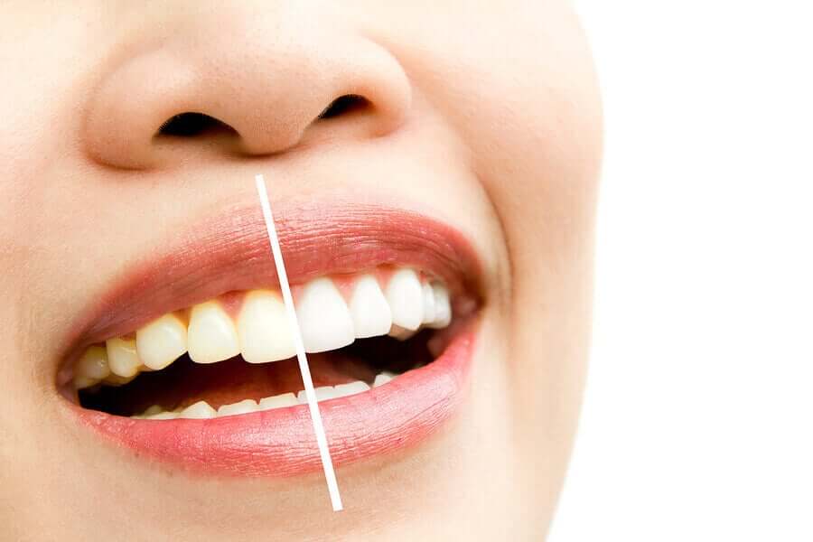 Some teeth stains vs. white teeth.