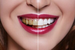 The Causes of Stained Teeth