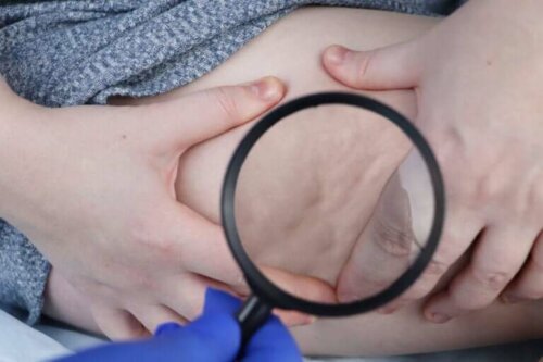 World Lipodystrophy Day: Why is it Celebrated?
