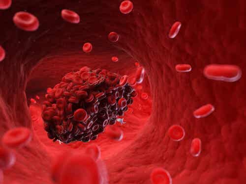 A blood clot.