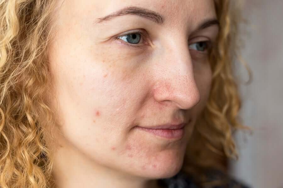 Cilt rahatsızlığı olan bir kadın