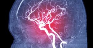 Symptoms, Types, and Causes of a Cerebral Embolism