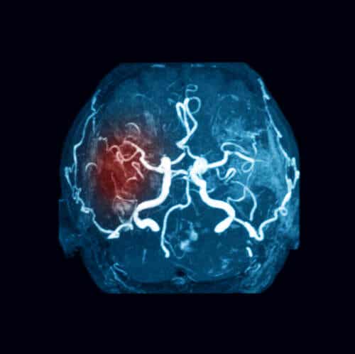 En illustrasjon av en blodpropp i hjernen.