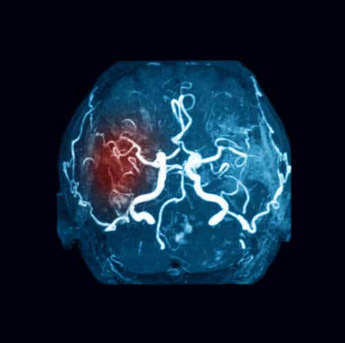 An illustration of a blood clot in the brain.