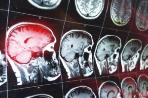 Intracranial Hematoma: What Is It and How Is It Treated?