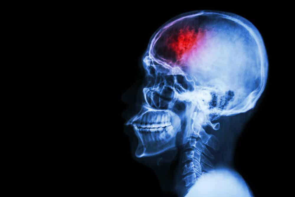 X ray of a head.