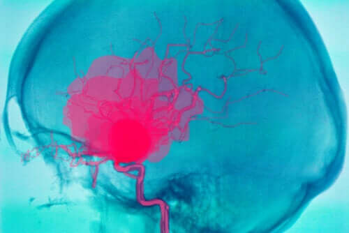 What's an Intracerebral Hemorrhage and Why Might it Occur?