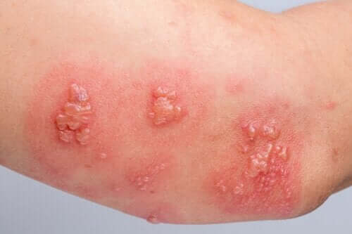 Bullous Pemphigoid: Causes, Symptoms and Treatment