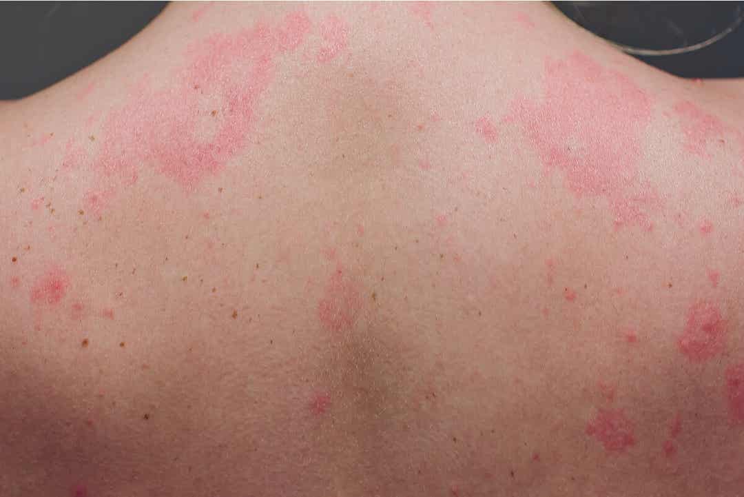 A woman with a rash all over her back.