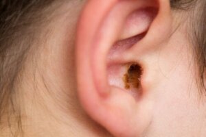 Characteristics of Cerumen Impaction