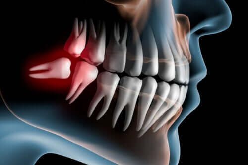 Symptoms of Impacted Wisdom Teeth and Treatment