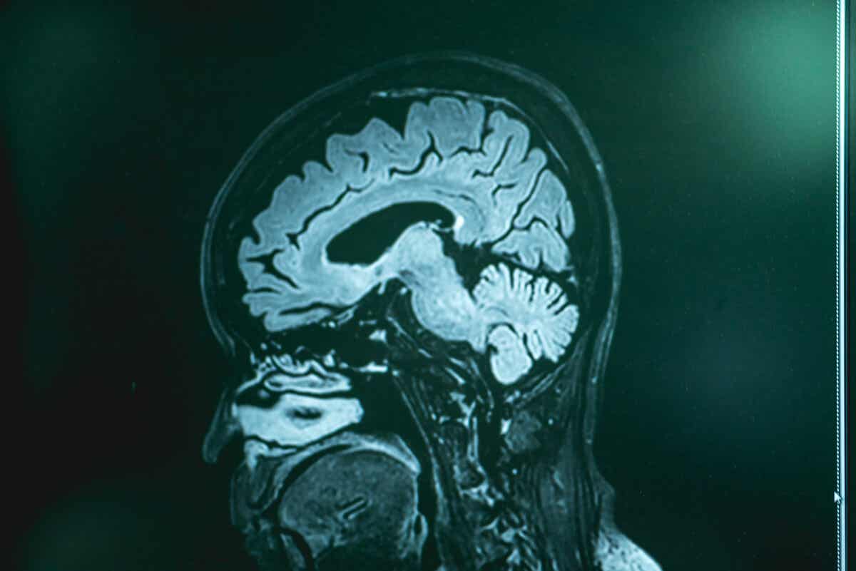 CAT scan of a brain
